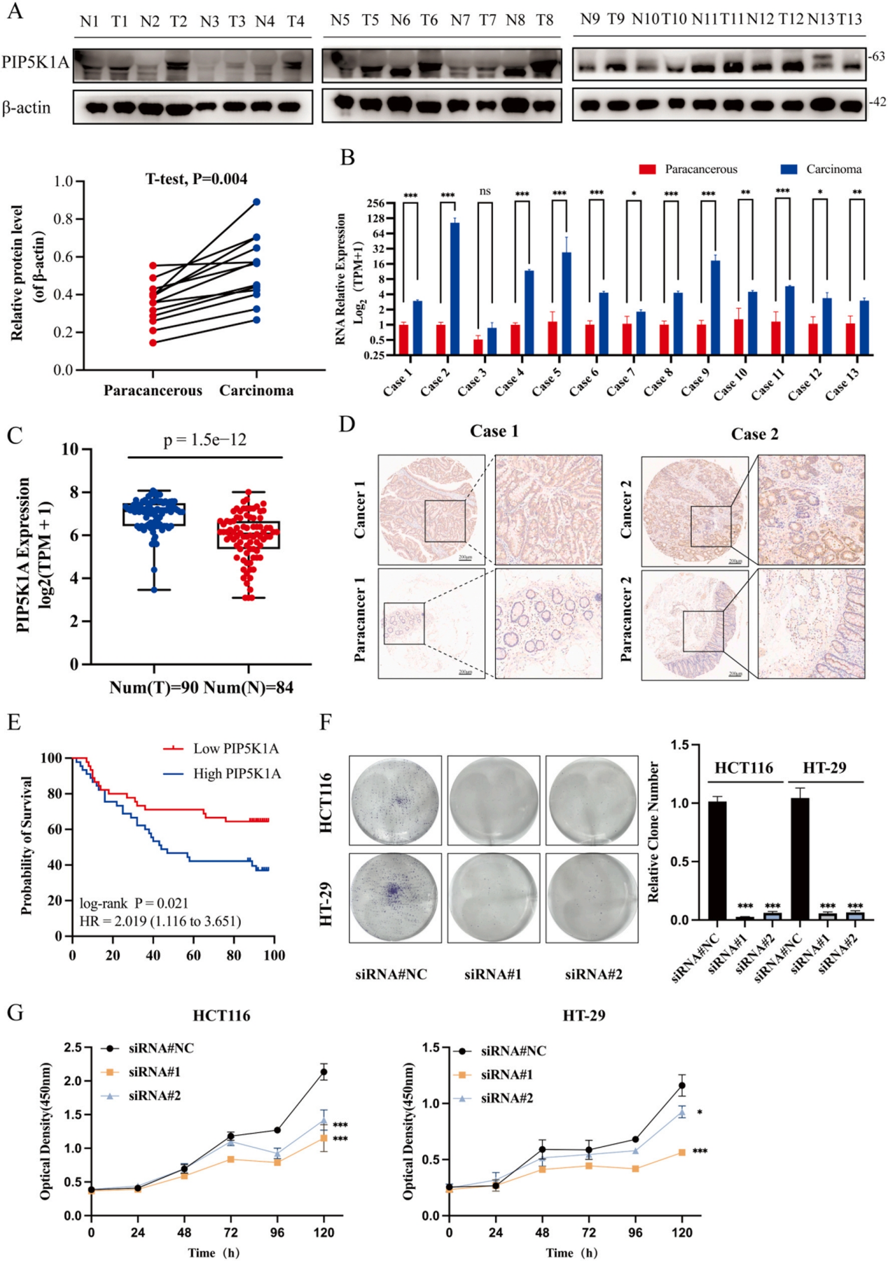 图1 PIP5K1A异常表达与结直肠癌进展的相关性.png